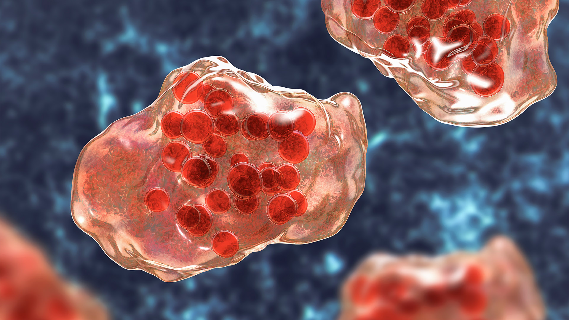 Illustration of measles virus infection showing giant multinucleated cells seen during microscopy of biopsy specimens, known as Warthin-Finkeldey giant cells.