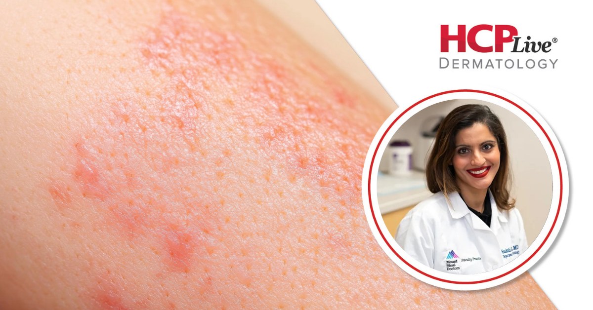 Psoriasis Tedavisinde Yeni Yaklaşımlar ve Kilo Verme İlaçları: Saakshi Khattri ile