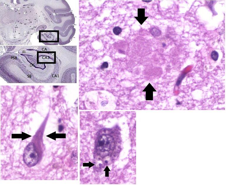 Alzheimer hastası serebral korteks kesitinde nöropil amiloid plakları ve nöronal dejenerasyon
