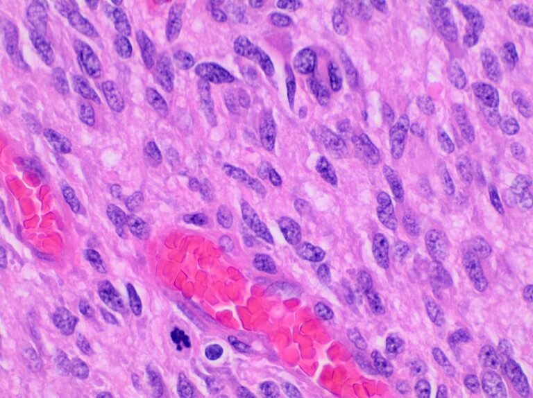 Glioblastoma dokusunda belirgin hücresel pleomorfizm ve mikrovasküler proliferasyonu gösteren yüksek büyütmeli H&E histopatoloji kesiti