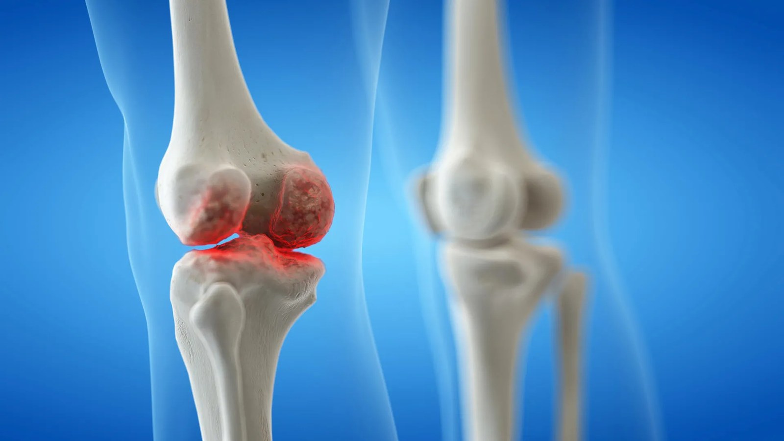 Knee osteoarthritis isn’t inevitable