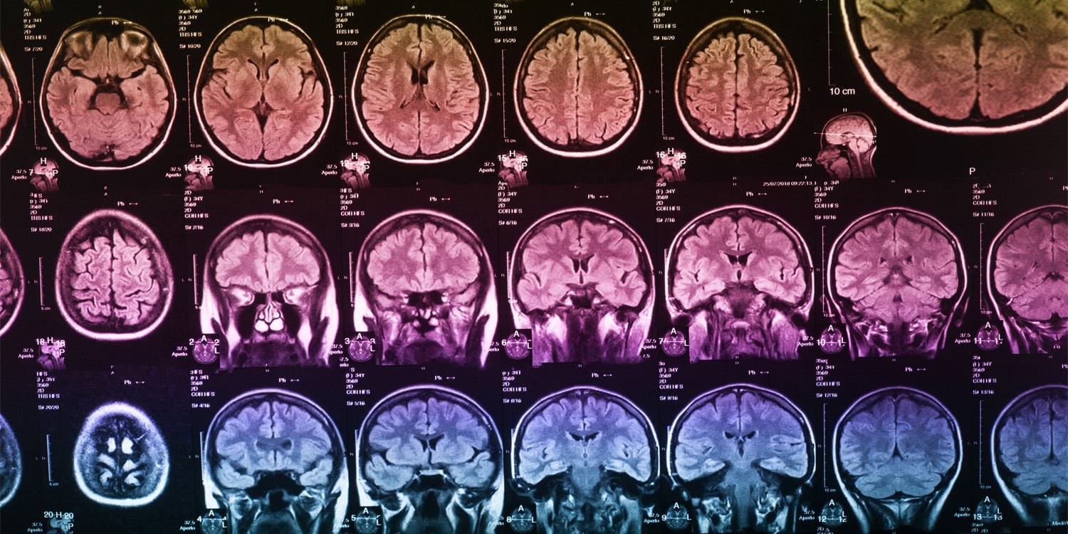 Tedaviye dirençli depresyon ile beyin entropisi arasındaki ilişki ortaya çıkarıldı