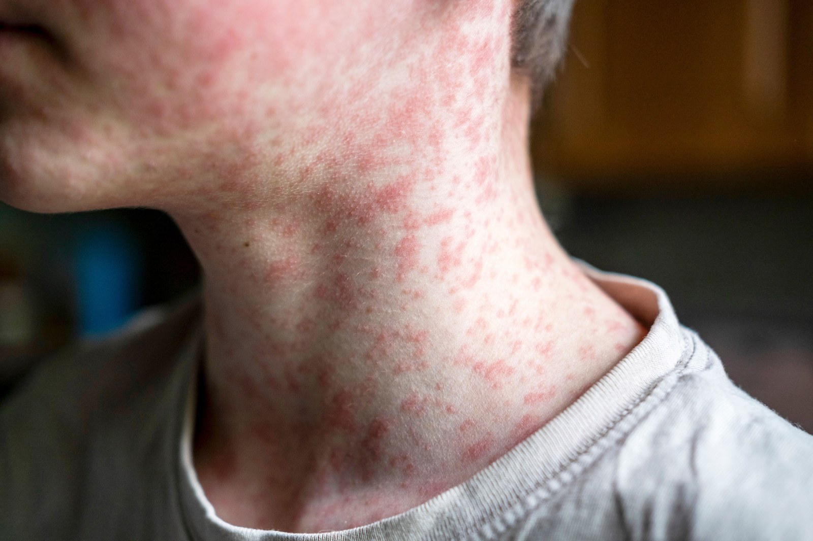 Pennsylvania Confirms First Measles Deaths in 35 Years as US Case Count Tops 2900