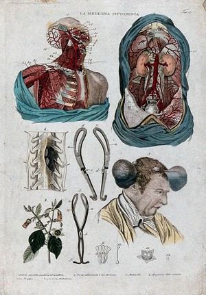 Anatomy and botany; top left, dissected head and chest; top right, dissected thorax; centre left, forceps; centre right, man with tumours on his head; bottom left, belladona plant. Coloured engraving, - Wellcome Tıp Tarihi Kütüphanesi