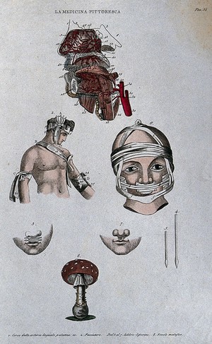 Anatomy, surgery and botany; top, dissected head showing arteries; centre, methods of bandaging the thorax and head; below, cleft lip (harelip) and instruments for surgery on  it; bottom, fly agaric m - Wellcome Tıp Tarihi Kütüphanesi