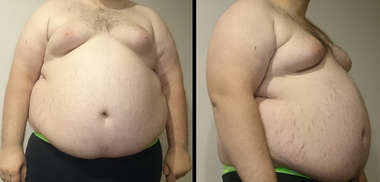 A "class III obese male" with a BMI of 53 kg/m2: weight 182 kg (401 lb), height 185 cm (6 ft 1 in). He presents with stretch marks and enlarged breasts.