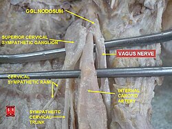 Internal carotid artery