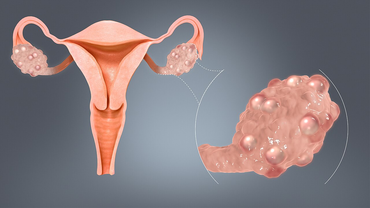 Image of multiple ovarian cysts